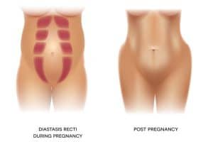 diastasis recti and rectus abdominis