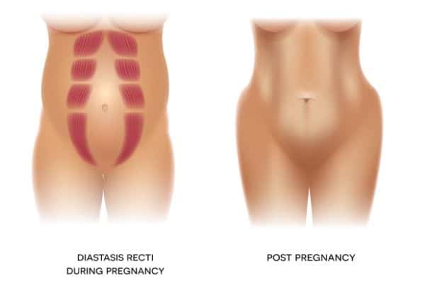 Diastasis Recti! OH MY! How This Mom Closed The Gap, Lost the Pooch, and  Got Back To Running Strong